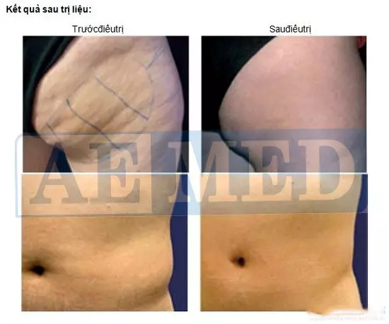 Giảm béo bằng máy Max Thin Lipo