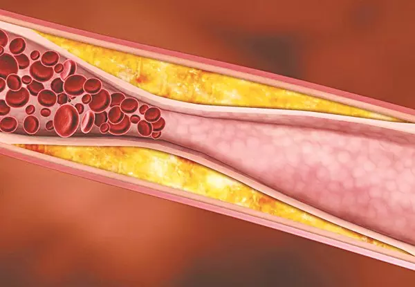 Triglycerid