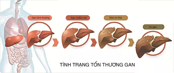 Chỉ số mỡ máu