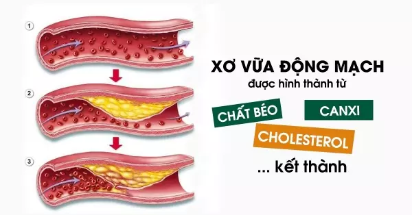 Biện pháp phòng ngừa mỡ máu cao