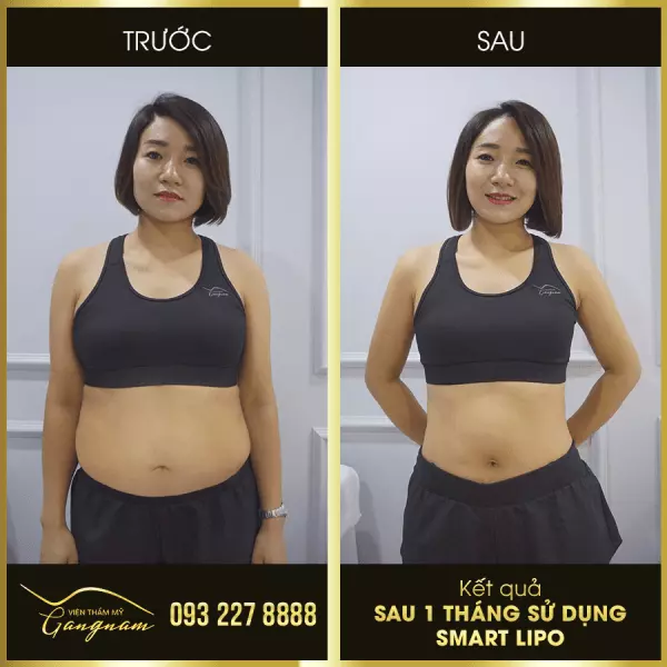 Chị Bích Thủy (36 tuổi) giảm 6 kg & 36 cm vòng bụng sau 1 tháng cấy tinh chất hủy mỡ Smart Lipo