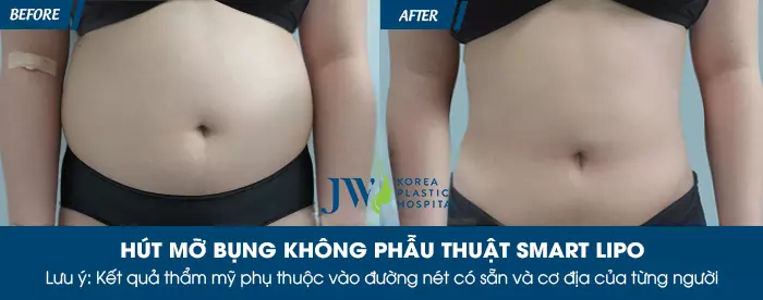 Hình ảnh thực tế của khách hàng trước và sau khi giảm mỡ Smart Lipo