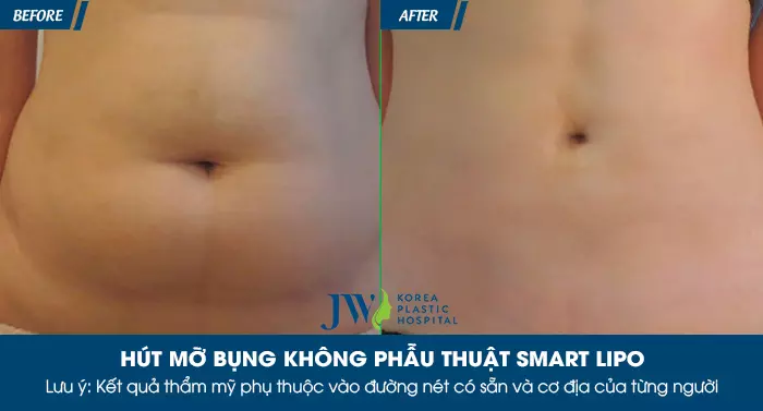 Khách hàng sở hữu vòng eo thon gọn, phẳng lì sau khi hút mỡ không phẫu thuật Smart Lipo.