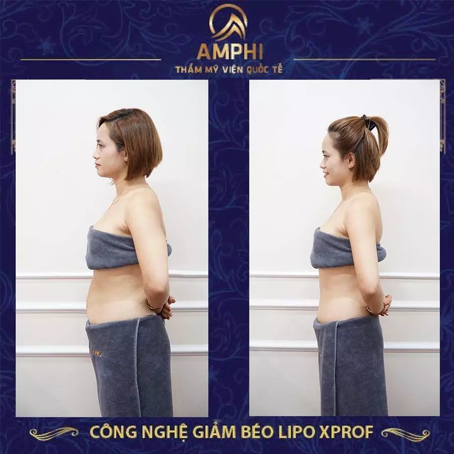 Giảm béo Lipo XProF tại thẩm mỹ viện AMPHI