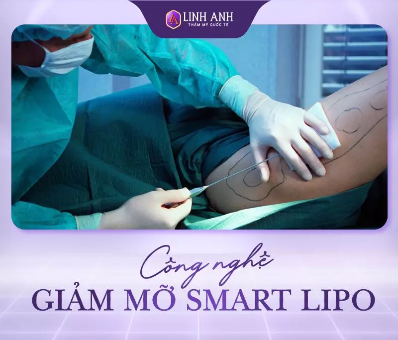 Công nghệ giảm mỡ Smart Lipo