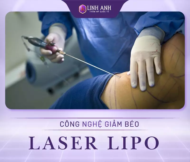 Công nghệ giảm mỡ bằng Laser Lipo