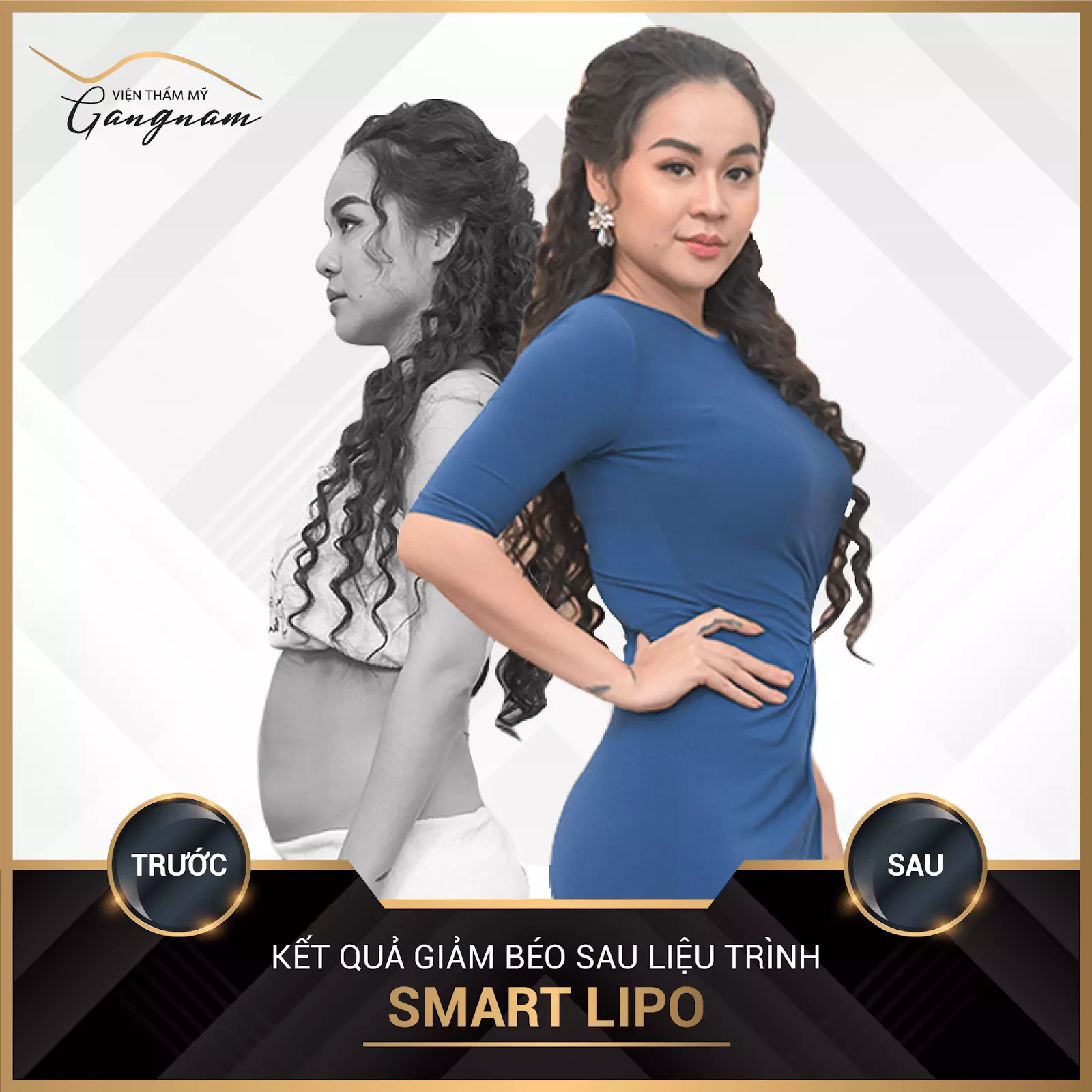 Ca sĩ Vũ Hạnh Nguyên lựa chọn Smart Lipo để giảm mỡ thân trên, lấy lại vóc dáng hài hòa cho cơ thể