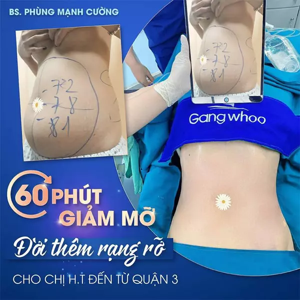 Hình ảnh thực tế giảm béo bụng bằng công nghệ Lipo Thin Max