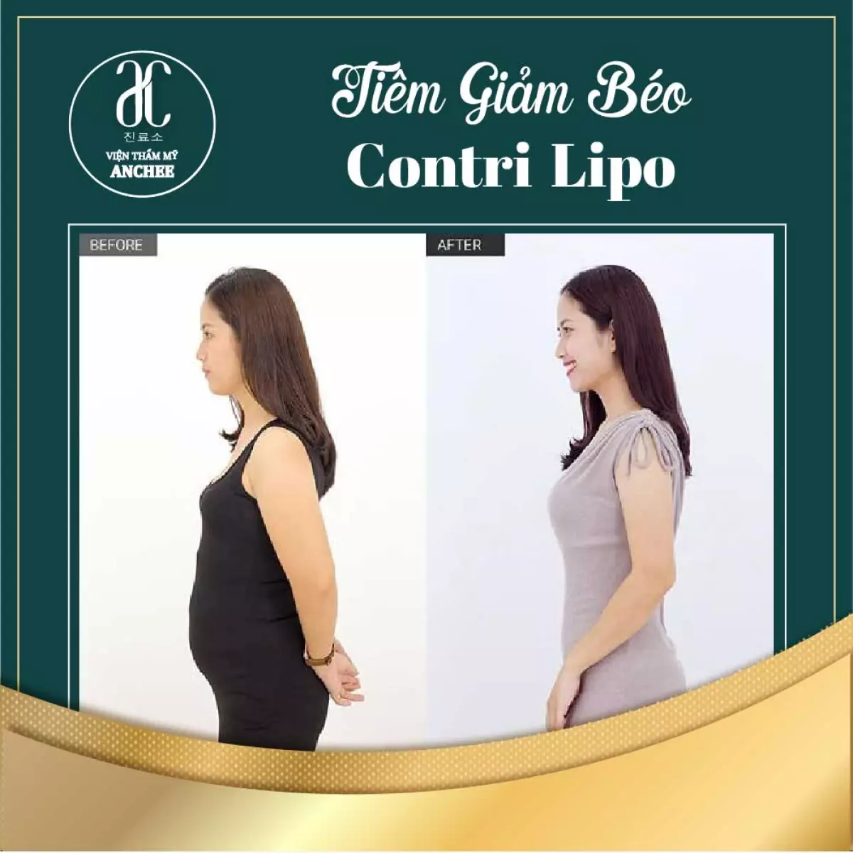 Tiêm giảm béo CONTRI LIPO có hiệu quả không? Giá bao nhiêu? Bảng giá [2022]