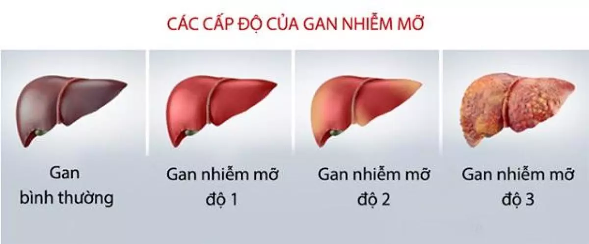 Gan nhiễm mỡ độ 1 có thể điều trị khỏi hoàn toàn?