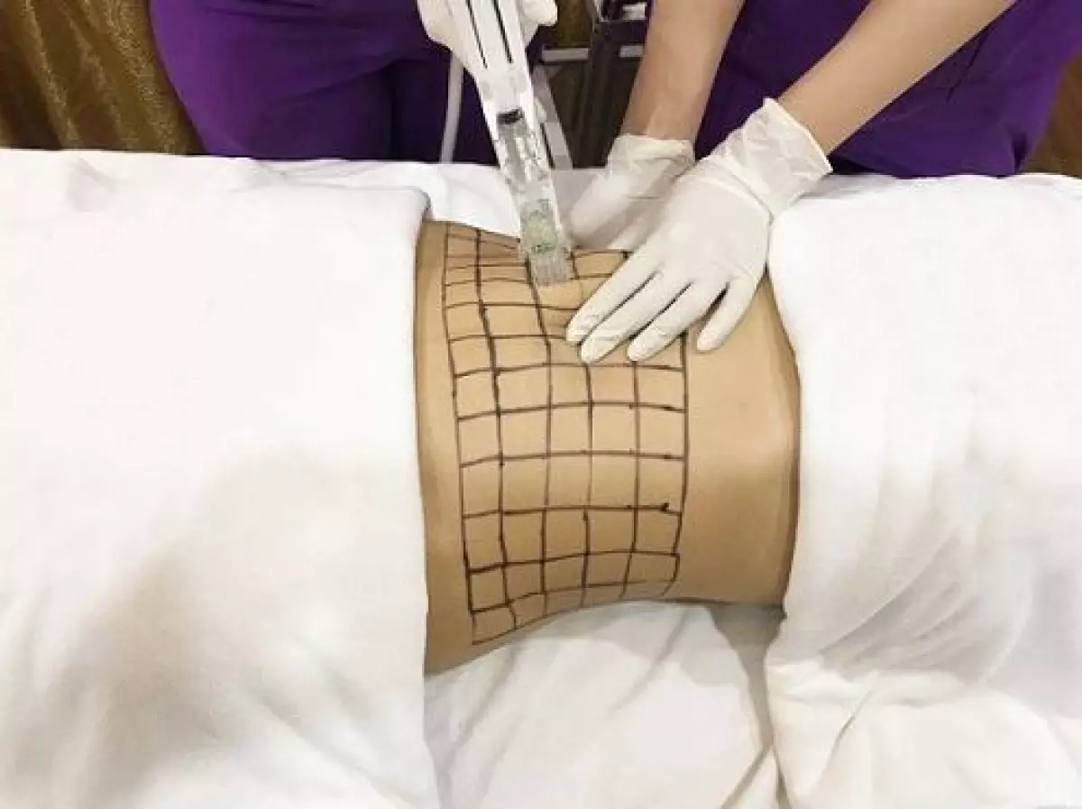 Công nghệ Max Thin Lipo