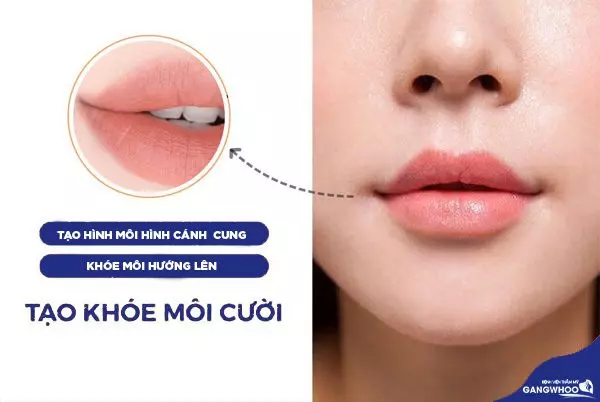 Bảng giá tạo hình môi cười