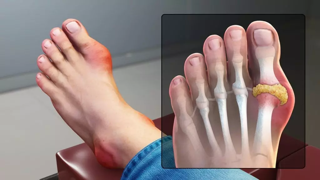 Gout có thể cải thiện nếu chế độ ăn chứa nhiều vitamin C