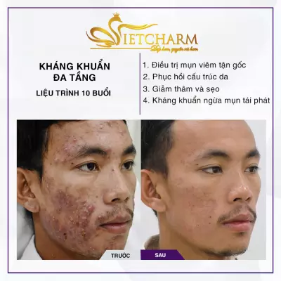 Liệu trình điều trị mụn 10 buổi chuyên sâu tại Vietcharm