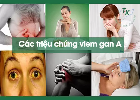 Điều trị và phòng ngừa bệnh viêm gan A