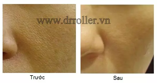 Hiệu quả trắng da với Dr. Roller