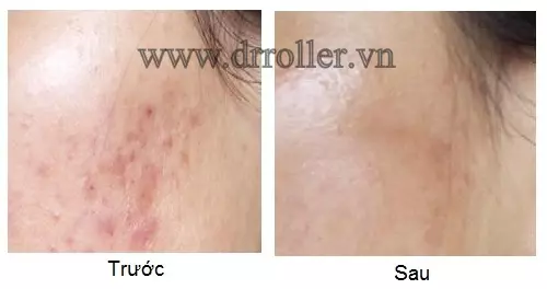 Hiệu quả trị mụn với Dr. Roller