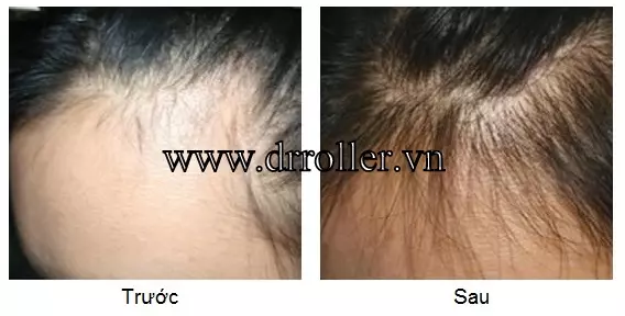 Hiệu quả trị hói đầu với Dr. Roller