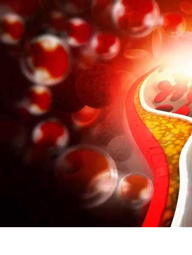   Rối loạn lipid máu: Hiểu nguyên nhân, cách điều trị và phòng ngừa