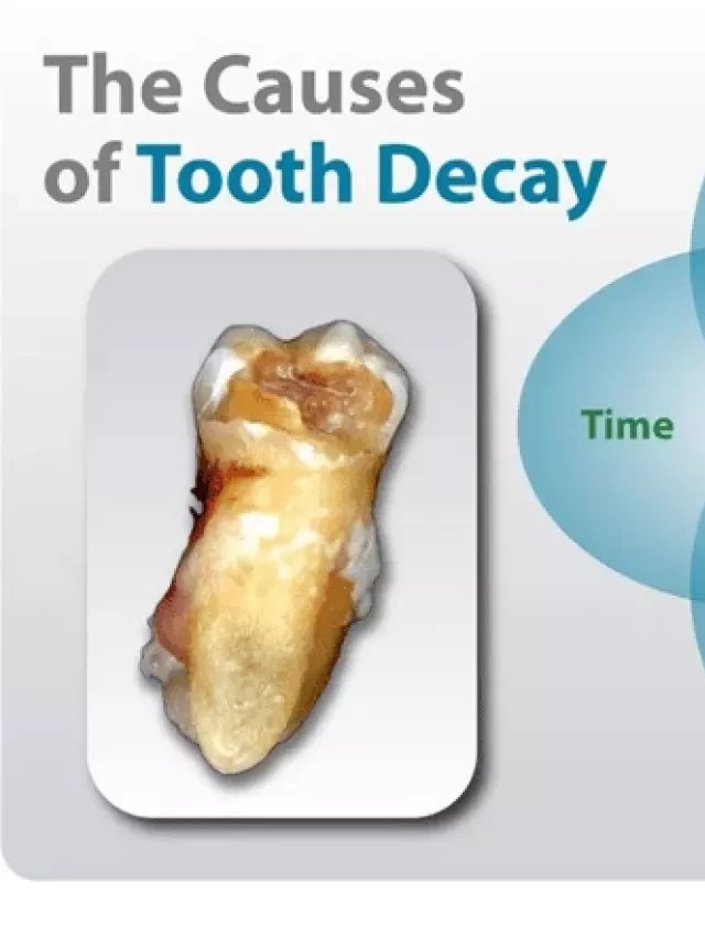   Đường lactose trong sữa mẹ có gây sâu răng? Những ngộ nhận tai hại về sữa mẹ