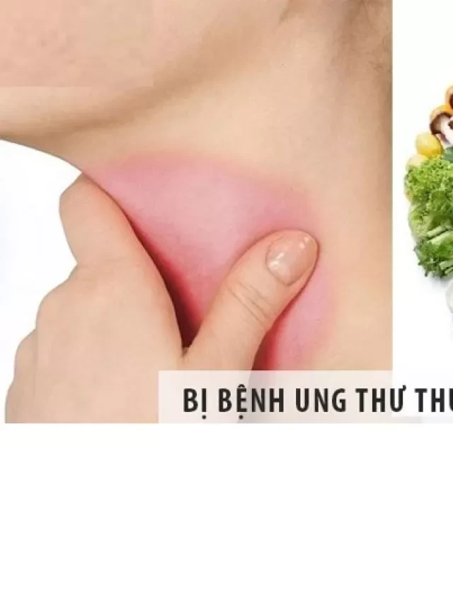   Dinh dưỡng trong điều trị ung thư thực quản