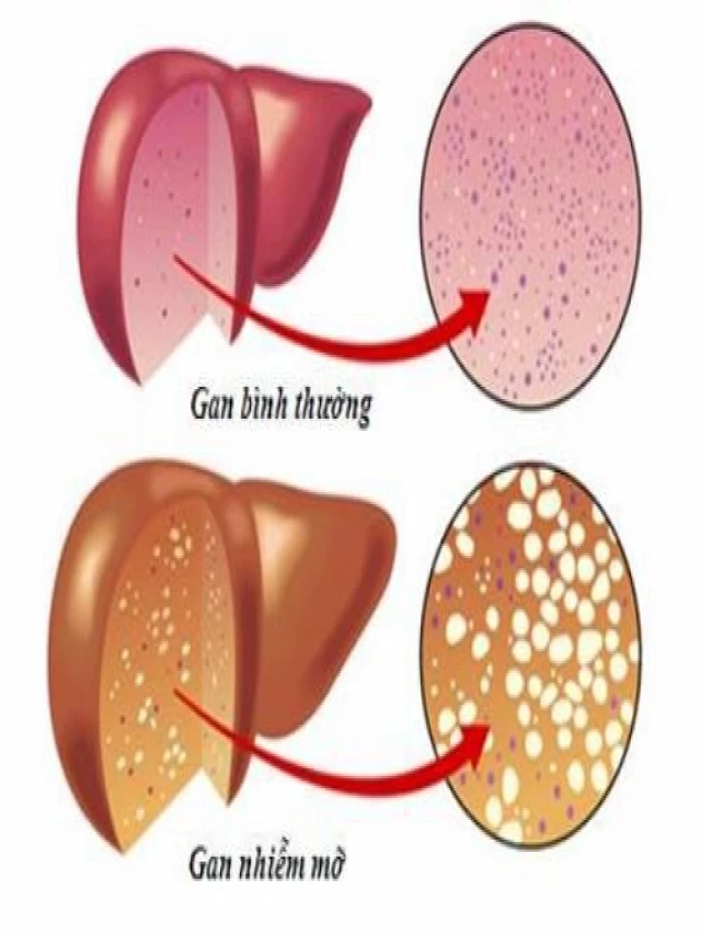   Mối Liên Hệ Tương Quan Giữa Gan Nhiễm Mỡ Và Máu Nhiễm Mỡ