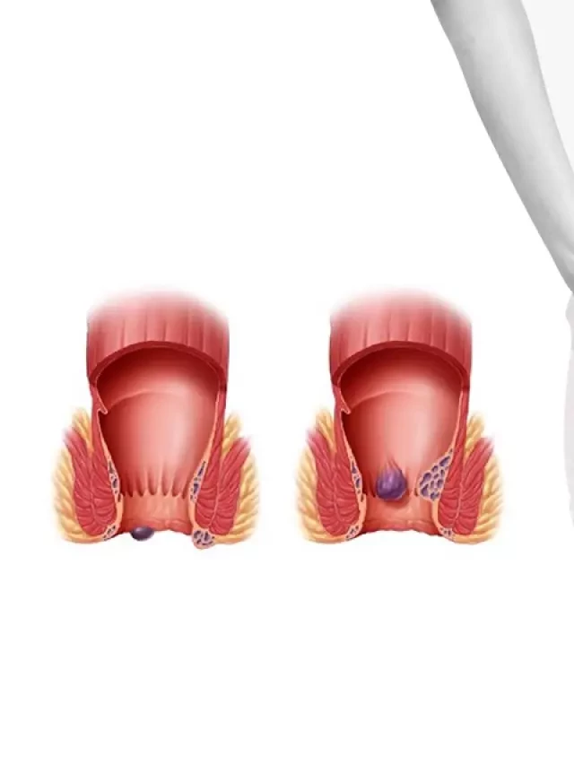   Chế độ dinh dưỡng cho người bị bệnh trĩ: ăn gì và không nên ăn gì?