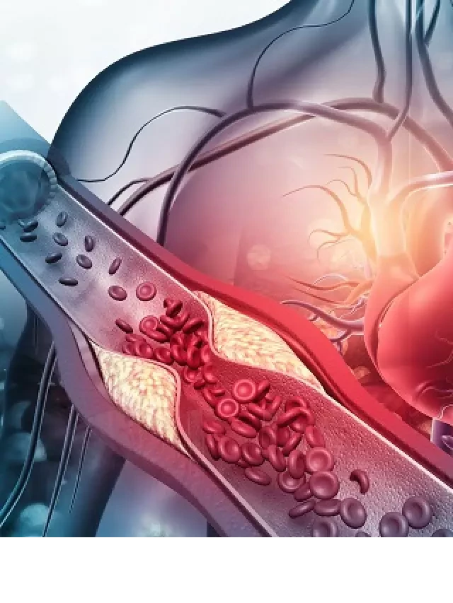   Cholesterol - Hiểu rõ hơn về loại chất quan trọng trong cơ thể và cách giảm cholesterol máu