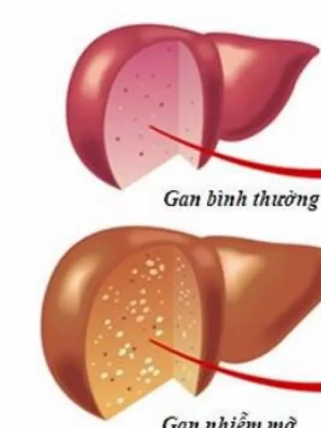   Chế độ dinh dưỡng tối ưu cho người bị gan nhiễm mỡ