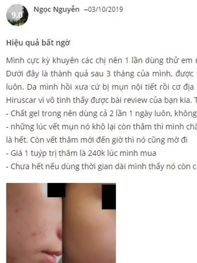   Review Hiruscar Post Acne - Kem hỗ trợ trị thâm do mụn có tốt không?