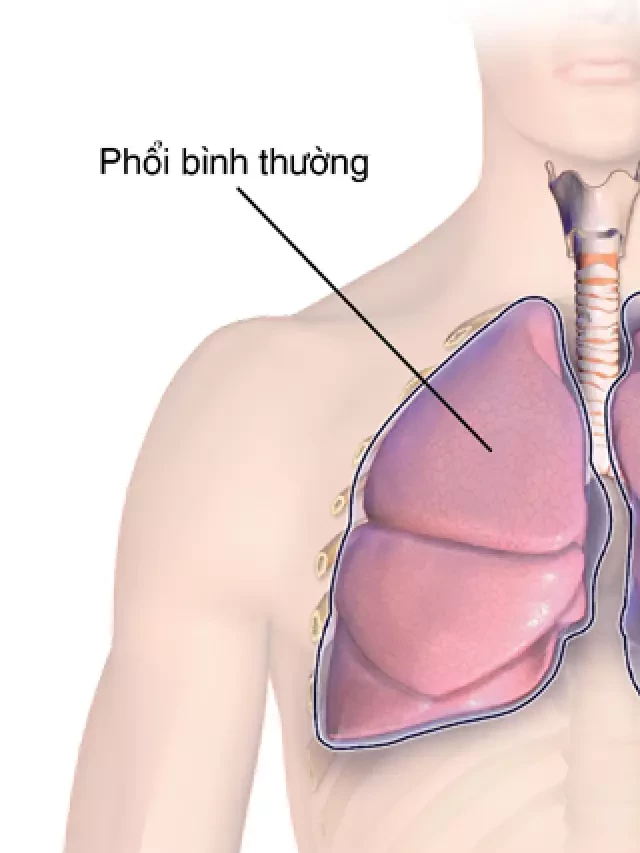   Bệnh hen phế quản bội nhiễm: Biến chứng nguy hiểm và cách phòng tránh