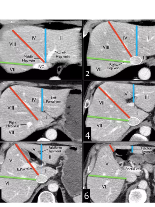   Tiếng Anh Y Khoa Chẩn Đoán Hình Ảnh: Giải Phẫu Phân Thùy Gan