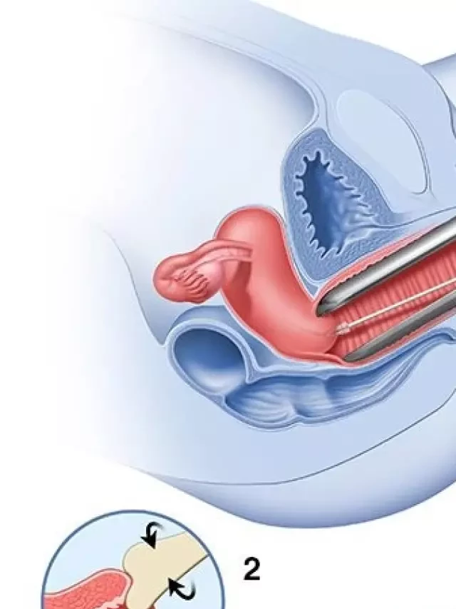   XÉT NGHIỆM PAP PHÁT HIỆN SỚM UNG THƯ CỔ TỬ CUNG