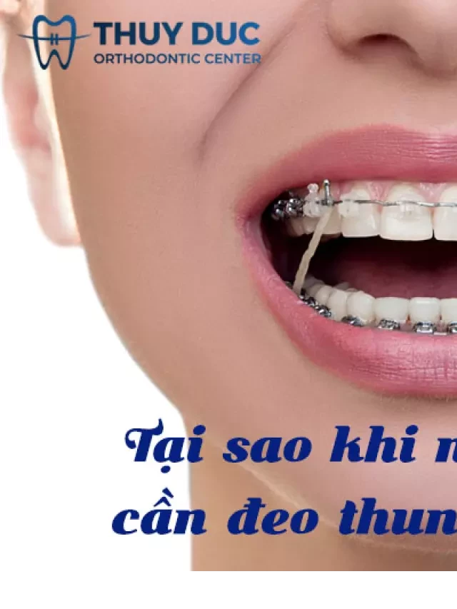   Tại sao bạn cần đeo thun liên hàm khi niềng răng?